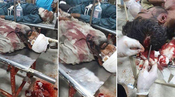 Very few Injured People of hundreds in different hospitals in Islamabad